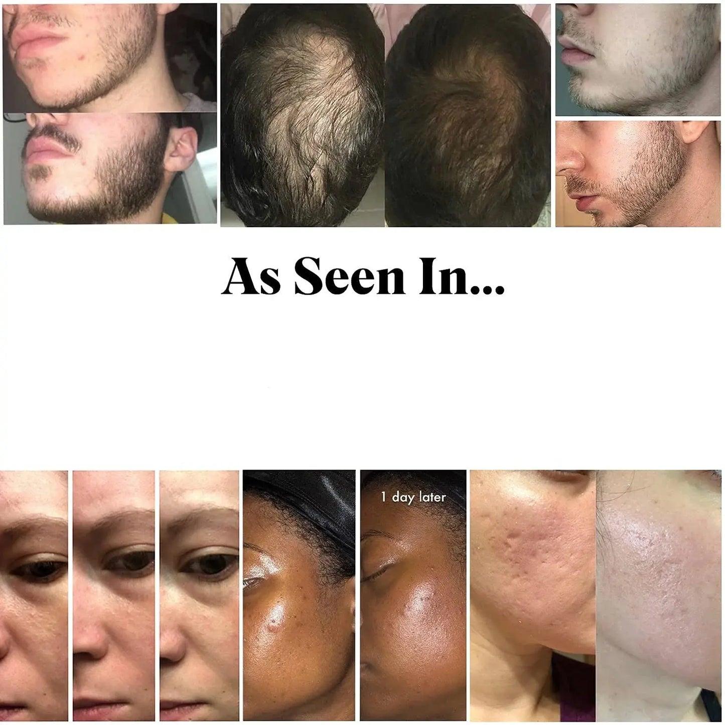 Derma Roller Skin Care Needle Micro Beauty Roller Drovia